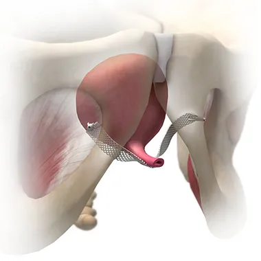 single-incision-sling-system